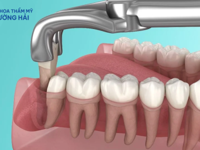 Dịch vụ nhổ răng khôn